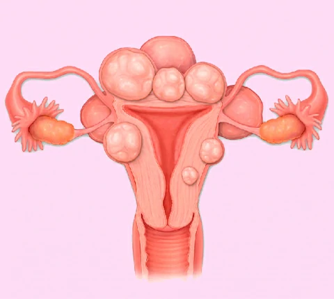 sindrome ovario poliquistico
